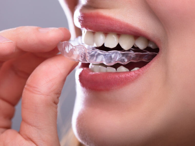 Fixing your Teeth While Using The Invisalign