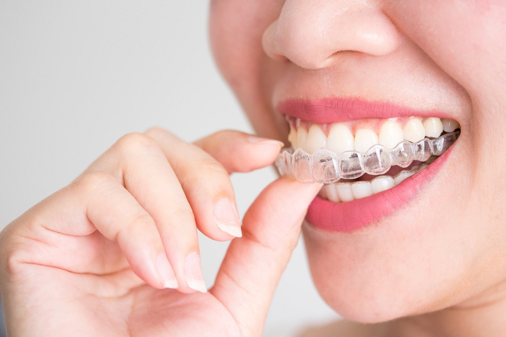 Clearer Smiles: An Overview Of Invisalign Orthodontics