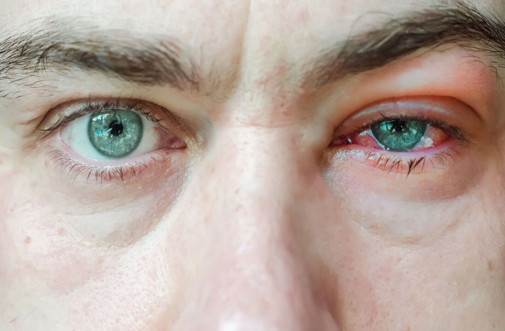 Everything You Need To Know About Blepharitis Treatments