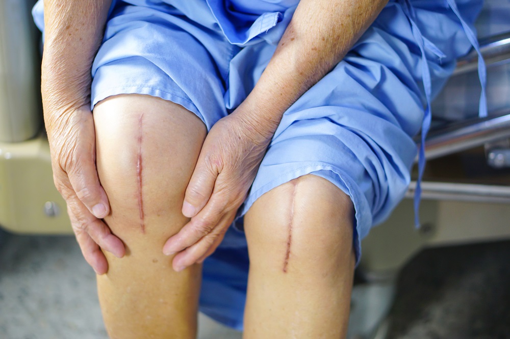 Revolutionizing Knee Surgery: Experience Advanced Precision And Faster Recovery