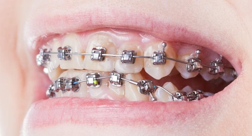 Self-Ligating Braces: What Are They?
