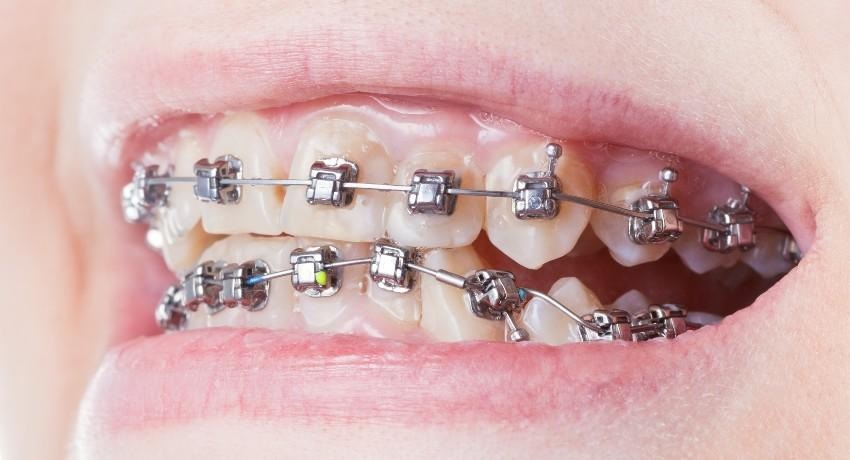 The Top 10 Benefits of Dental Implants