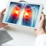 Lung Cancer's Early Warning Signs And Symptoms