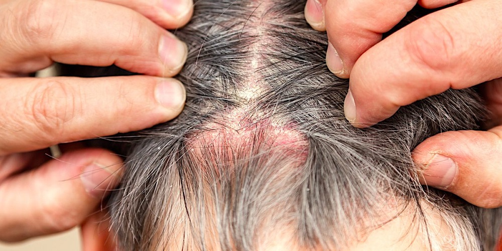 Scalp Psoriasis: The Symptoms, Causes & Why Vitastem Ultra is The Best Treatment