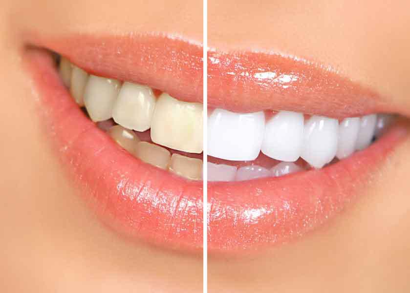 How Teeth Whitening Can Make a Huge Difference to a Person’s Confidence