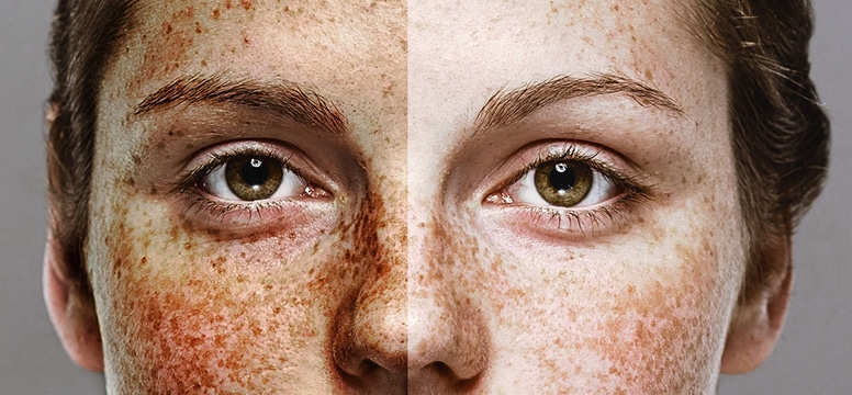 Why is it Necessary to Take Care of Our Skin from Sun Damage?