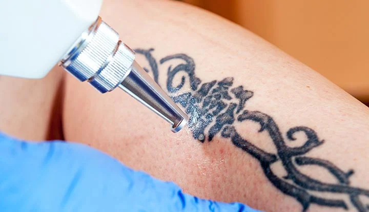 Everything You Need to Know About Tattoo Removal