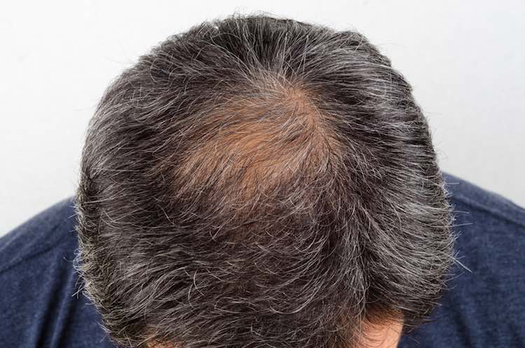 Common Hair Problems in Melbourne: Causes and Solutions