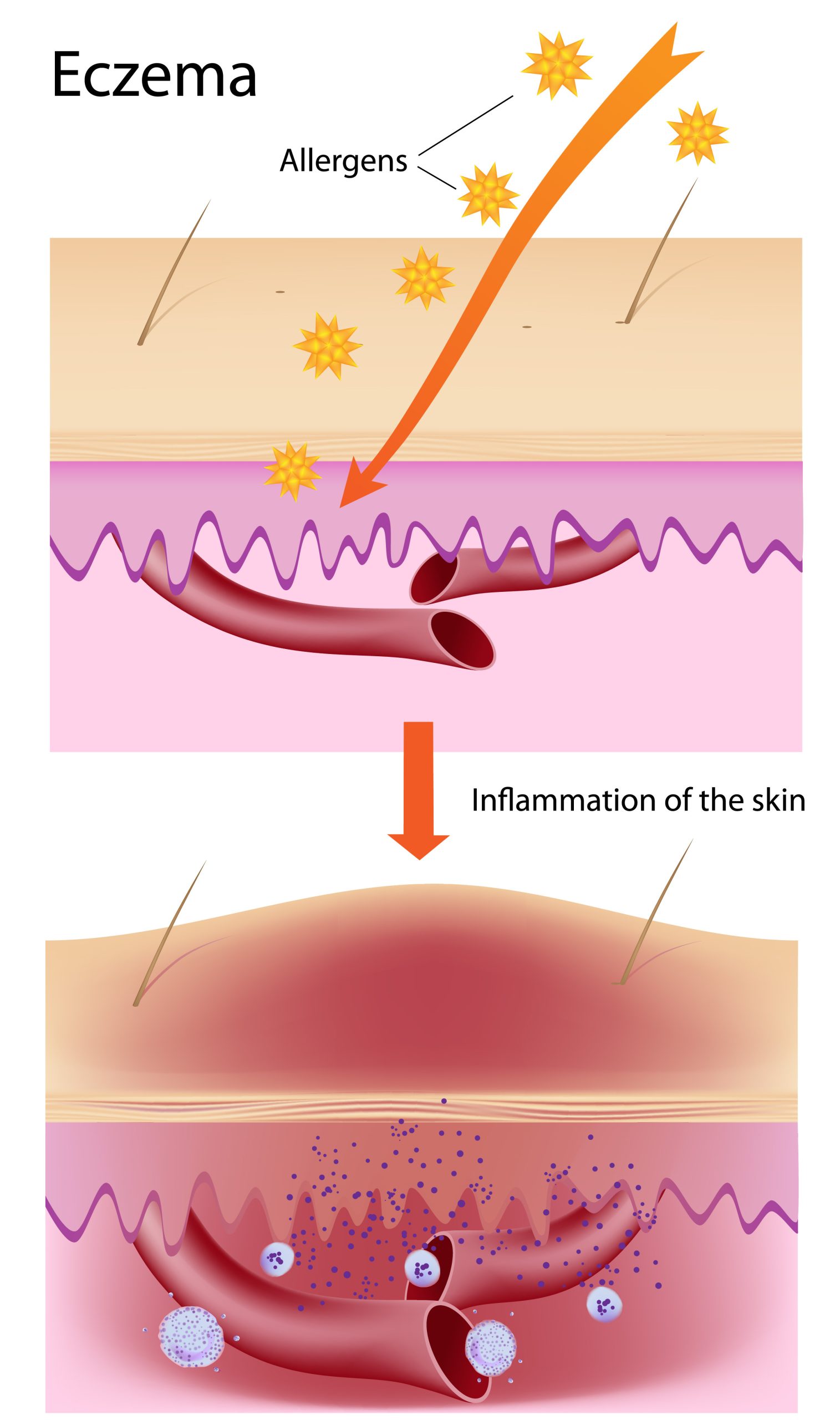 Eczema in Infants and Children: Pathophysiology, Locations, and Management