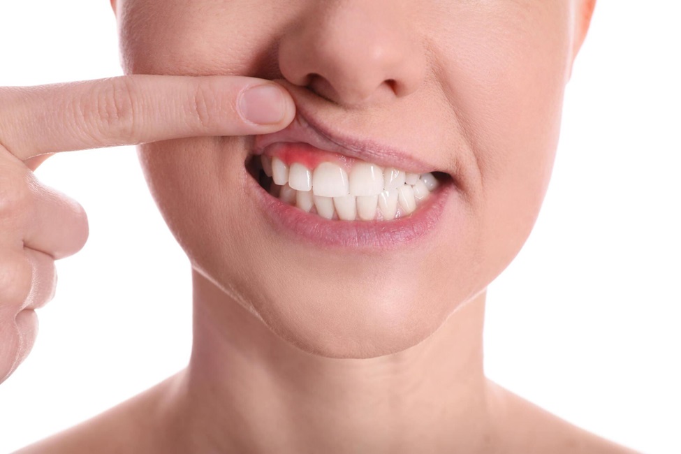 When to Seek Treatment for Gum Disease: A Guide for Patients