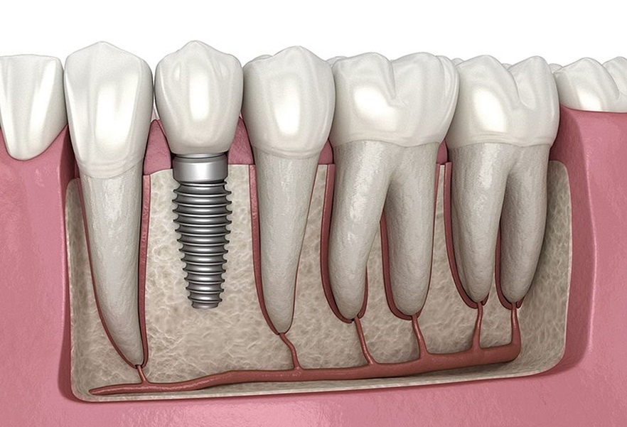 Top Benefits of Dental Implants