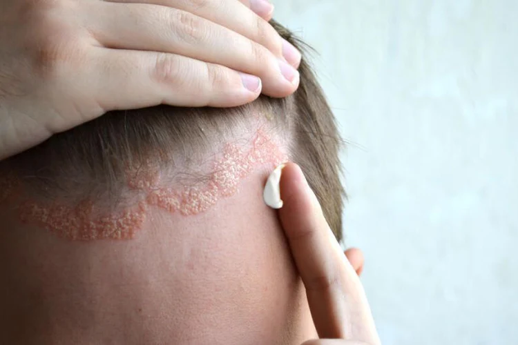 Seborrheic Dermatitis Treatment for Face and Scalp