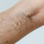 varicose veins in Singapore