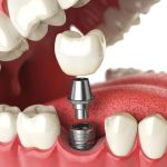 Dental