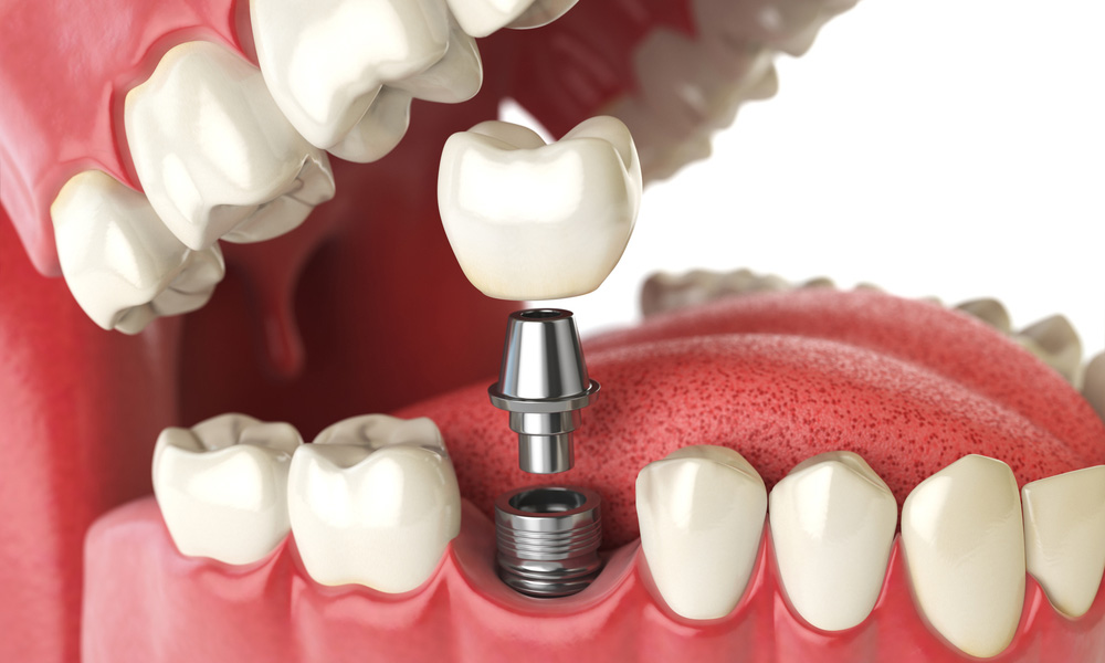 Transforming Your Smile: How Teeth Replacement Can Boost Your Confidence with TeethXpress