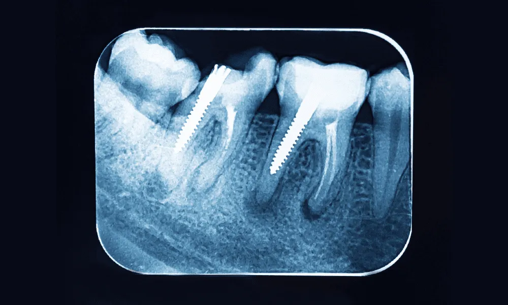 Types of pediatric dental x-rays – When they’re necessary?