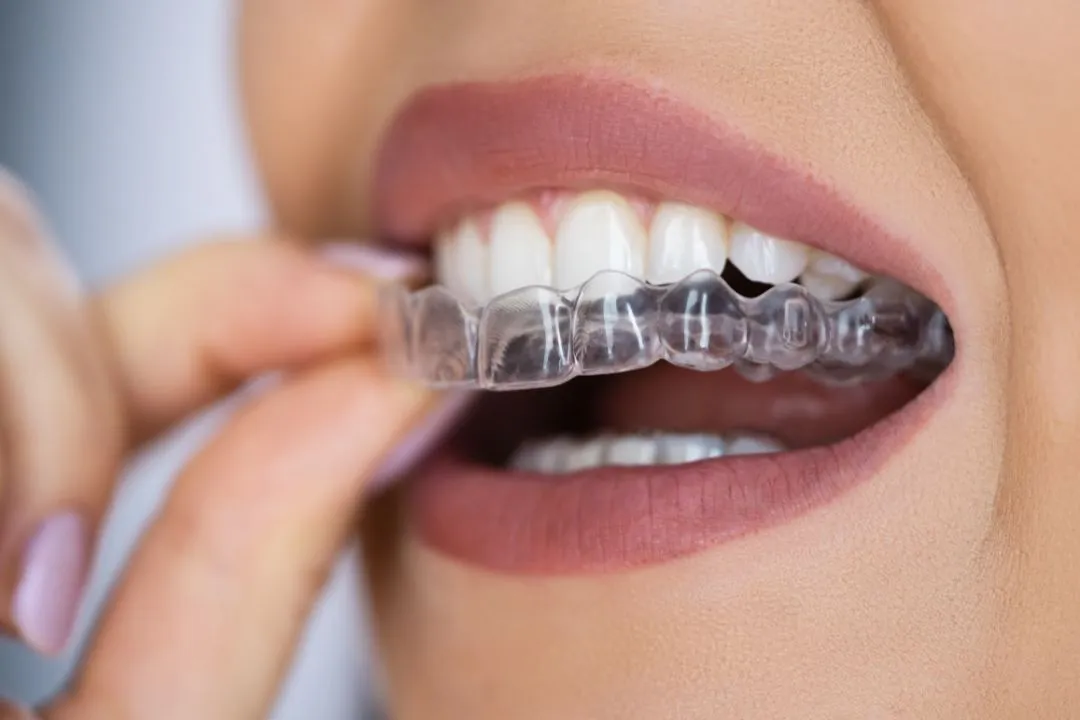 Why clear aligners are the preferred choice for adults.
